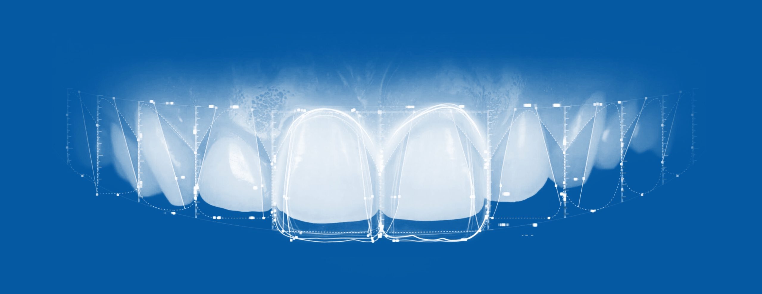 Carillas Dentales en Alboraya