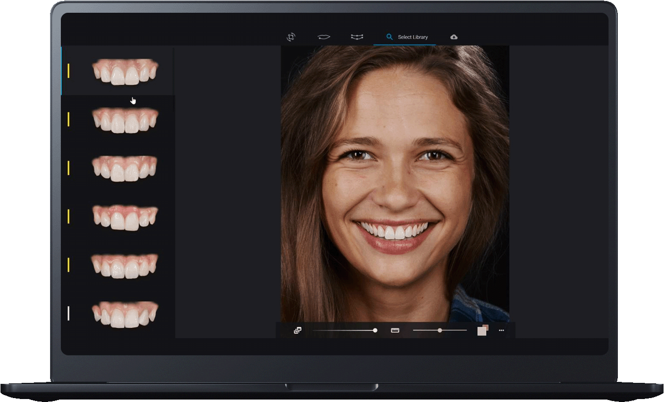 carillas dentales en Alboraya